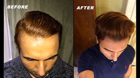 Receding Hairline Stages Signs Treatment