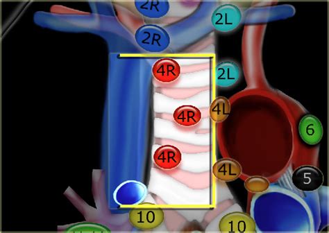 The Radiology Assistant : Mediastinum - Lymph Node Map