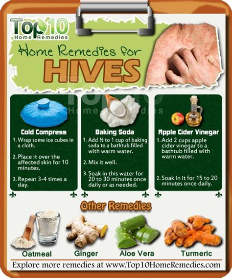 Home Remedies for Hives | Top 10 Home Remedies