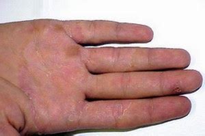 Hand Fungus – Symptoms, Causes, Pictures and Treatment