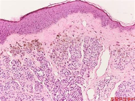 Nevus, Intradermal