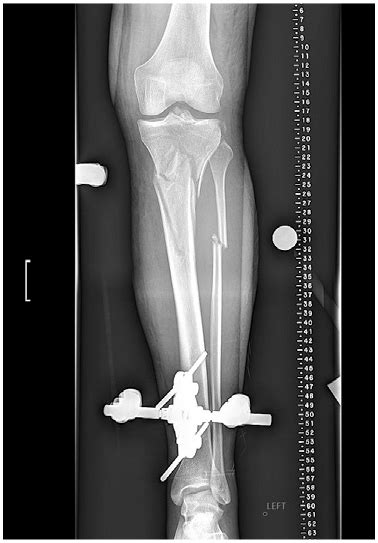 Managing High-Energy, Proximal Tibia and Fibula Fracture | HSS Case