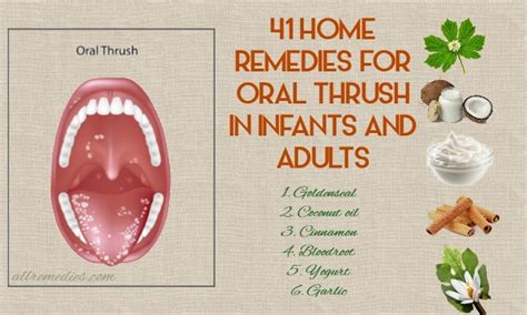 Treatment For Oral Thrush In Adults