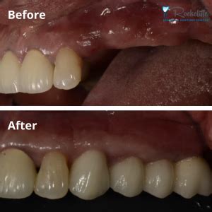 Dental Implant Bridges | Implant-Supported Bridges