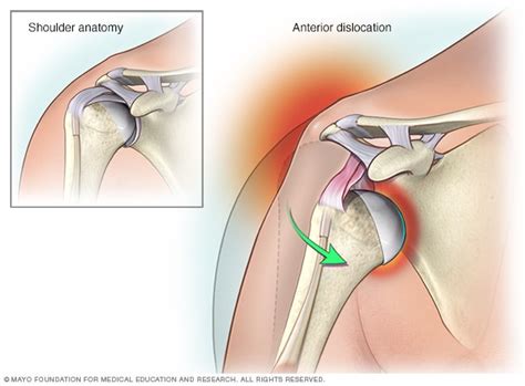 Michael Parkhurst Dislocated Shoulder | Sports Blog