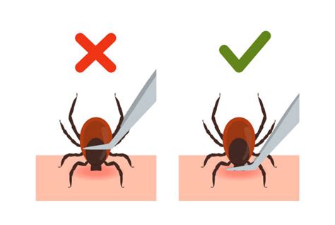 Tick Removal From Humans