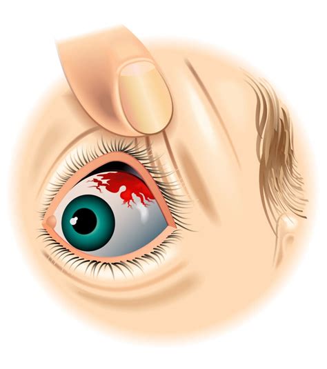 7 Causes of a Red Spot on Your Eye (And How to Treat Them)