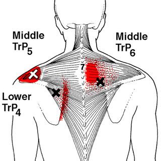 Referred pain patterns (red) from the upper and lower trapezius muscle ...