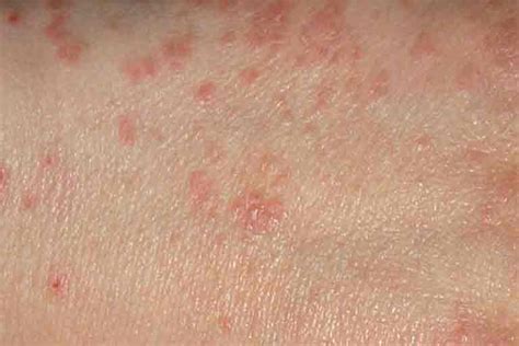 Scabies: Communicable Diseases: Public & Environmental Health ...