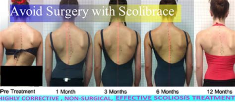 Scoliosis Treatment | Vancouver Chiropractic | Dr Kenny Chan