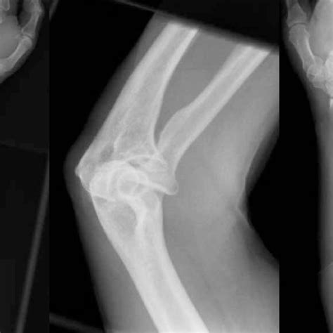 Radiographs showing an anterolateral dislocation of the radial head and ...