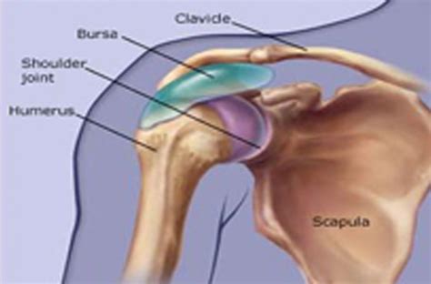 Shoulder Bursitis