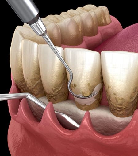 Flap Surgery & Gum Surgery in Hyderabad, India at FMS DENTAL