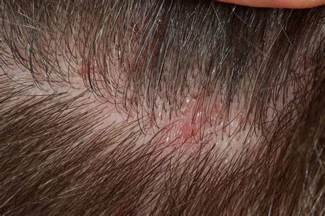 Frontal Fibrosing Alopecia and Lichen Planus Pilare: Diagnosis ...