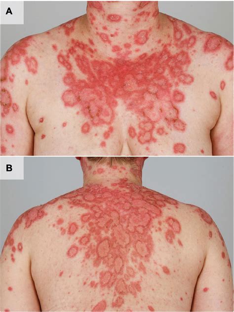 Chronic Cutaneous Lupus Erythematosus