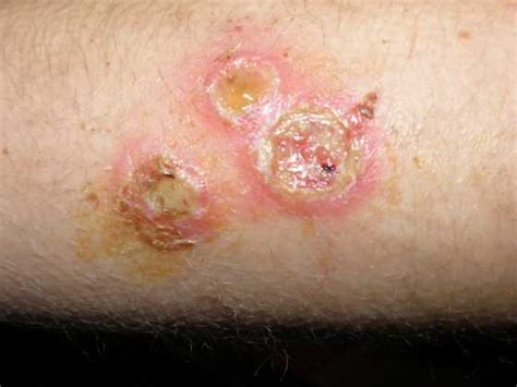 Staph Infection - Causes, Symptoms, Prevention, Treatment, Contagious ...