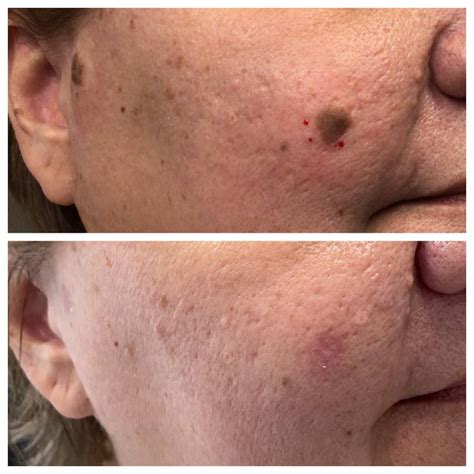 Seborrheic Keratosis Removal Before and After St. Louis Dermatology ...