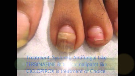 hand fungus treatment - pictures, photos