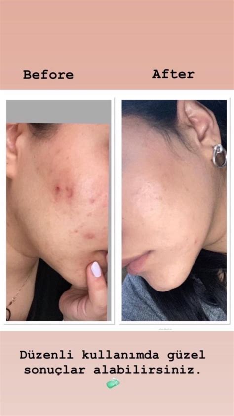 Dr derm skin results with before after pictures – Artofit