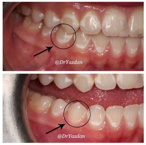 How To Prevent White Spots On Teeth - Rowwhole3