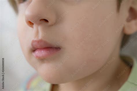 Close-up of a child with toothache, swollen cheek, gangrene. Problems ...