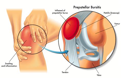 Prepatellar Knee Bursitis | Orchard Health Clinic - Osteopathy ...