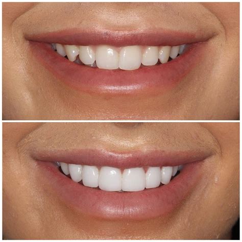 Teeth Veneers Before And After