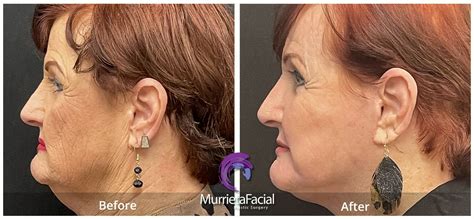 Laser Facelift – Murrieta Facial Plastic Surgery