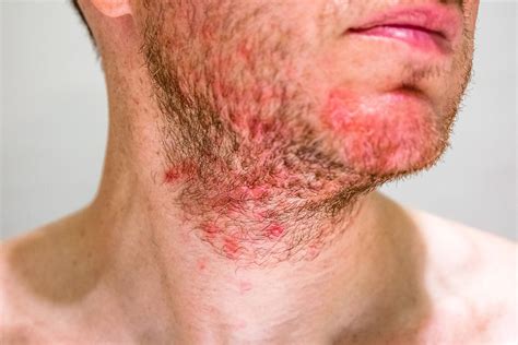 Beard Rash: A Four-Step Guide To Soothe and Prevent Future Breakouts ...