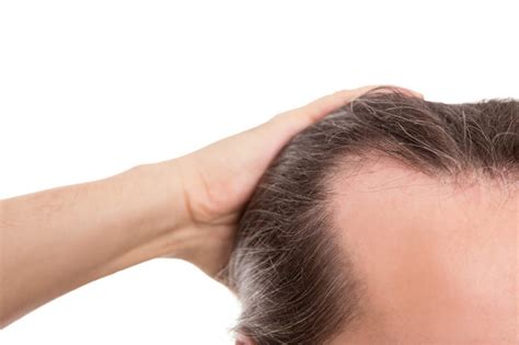 Combating a Receding Hairline | Causes, Symptoms, and Treatments