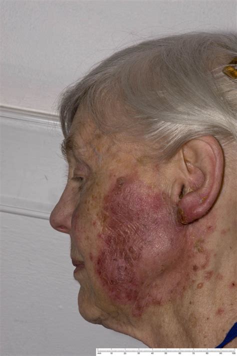 Subacute Cutaneous Lupus Face