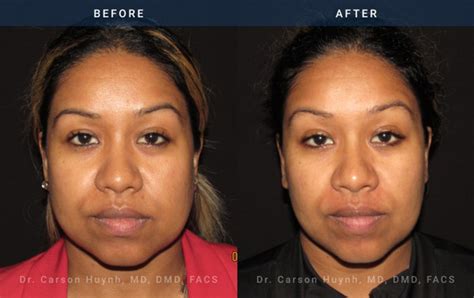 Buccal Fat Reduction Atlanta, GA | Radiance Surgery and Aesthetic Medicine