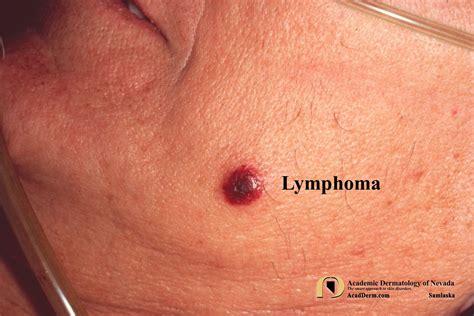 T Cell Lymphoma Skin Cancer