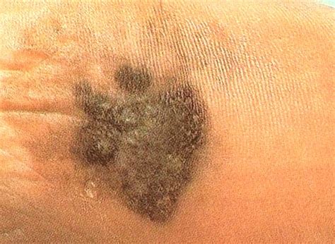 Acral Lentiginous Melanoma - Pictures, Treatment, Symptoms