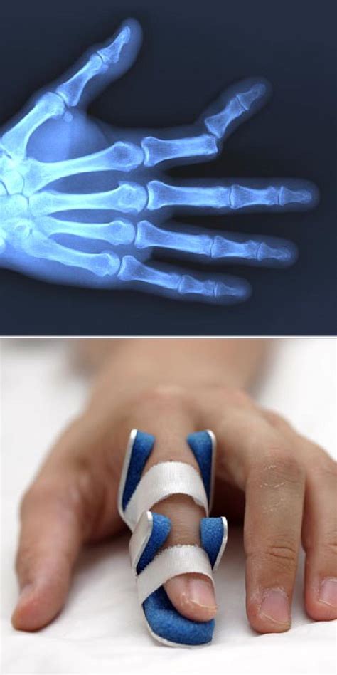 Finger Dislocation - Orthoriverside.com