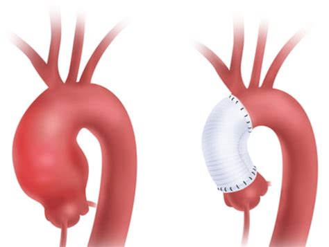 Ascending Aortic Aneurysm Treatment: What You Need to Know - The ...