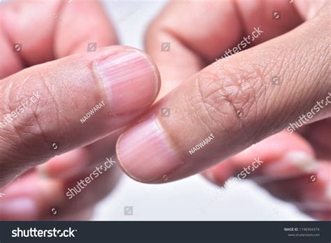 94 Vertical lines fingernails Images, Stock Photos & Vectors | Shutterstock