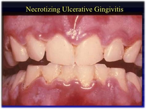 Necrotizing ulcerative gingivitis