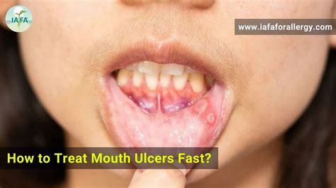 Mouth Ulcers Sores: Symptoms Treatment| Smile Generation