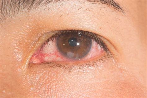 What is a Corneal Ulcer? :: Eye Health Central