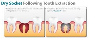 How to Smoke After Tooth Extraction without Getting Dry Socket ...