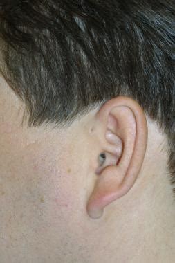 preauricular cyst excision