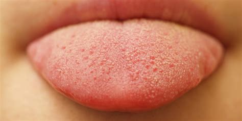 What Causes Bumps On Tongue | Images and Photos finder