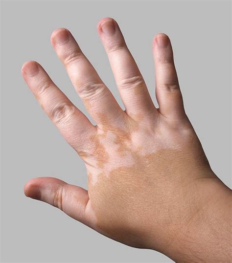 Vitiligo - symptoms, treatments and causes | healthdirect