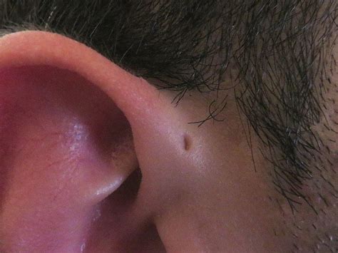 Preauricular sinus and cyst - Alchetron, the free social encyclopedia