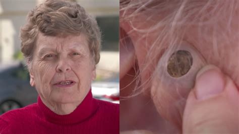 Ontario woman finally gets 55-year-old blackhead removed on TLC's 'Dr ...