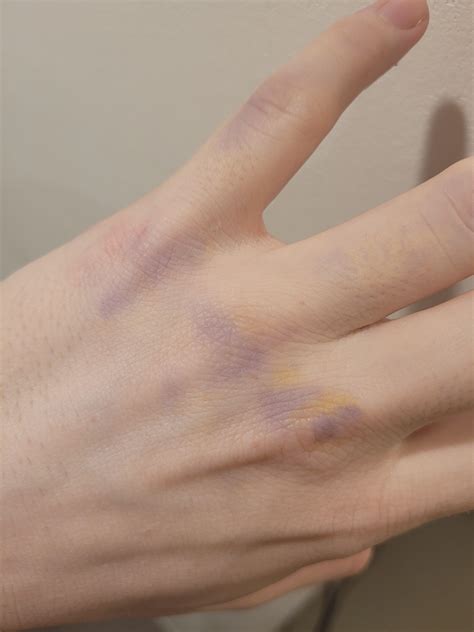 Hand turned purple and yellow and became very dizzy : r/medical_advice