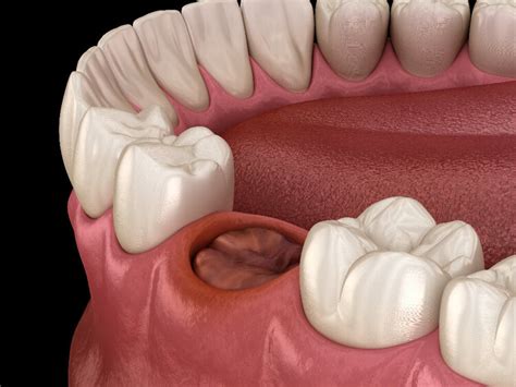 How to Avoid Dry Socket After Extraction | Santo Dental Group