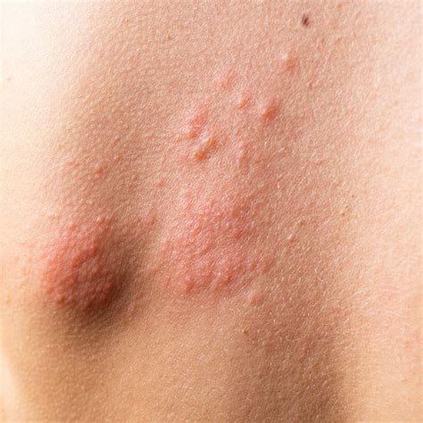 Hives vs Eczema