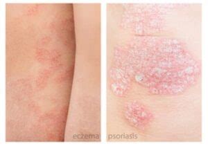 Is it Psoriasis or Eczema? - Alamo Heights Dermatology